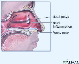 Nasal polyps Information | Mount Sinai - New York
